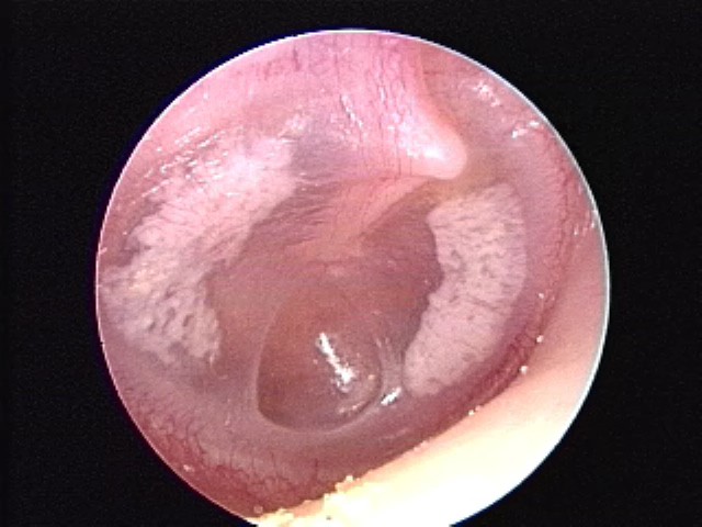 Tympanosclerosis with Retraction pocket
