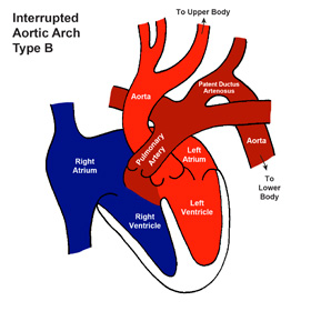 type 2 interrupted aortic arch